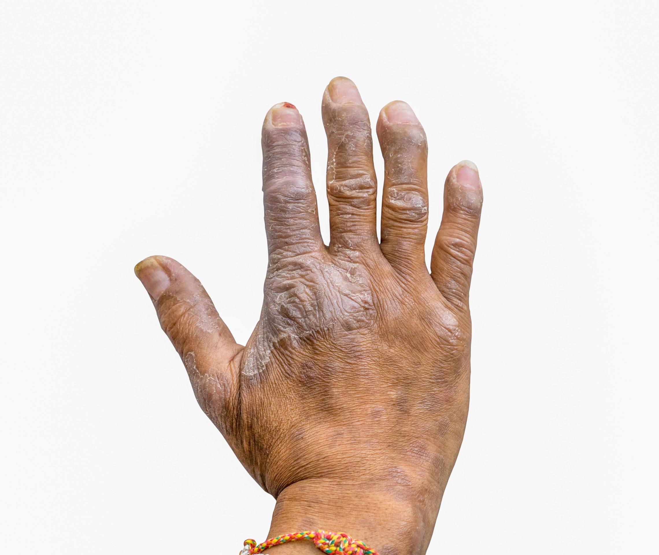 Nagelpsoriasis