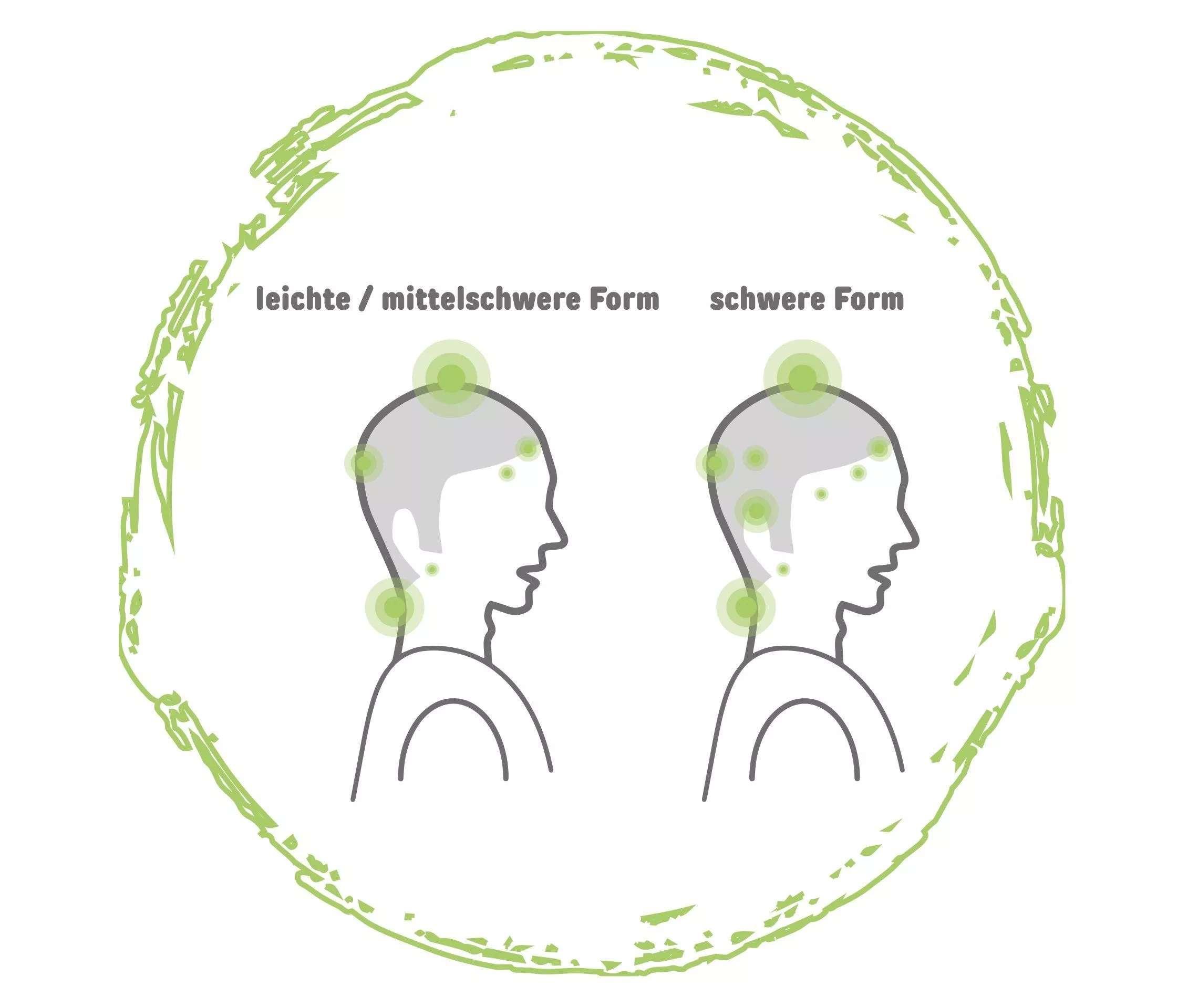 Grafik zwei Köpfe mit Psoriasis einer beschriftet mit leichte / mittelschwere Form und einer mit schwere Form