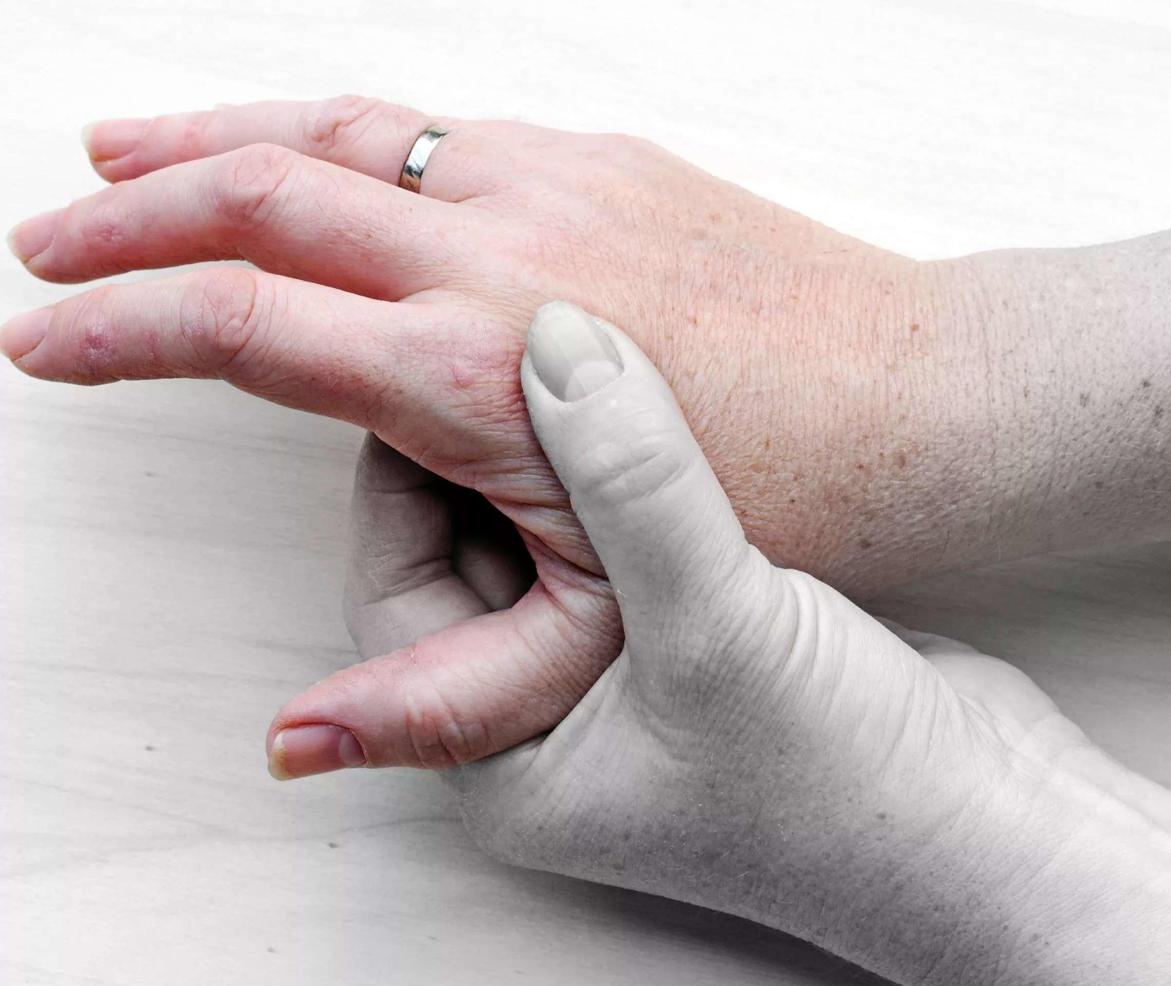 Psoriasis Arthritis