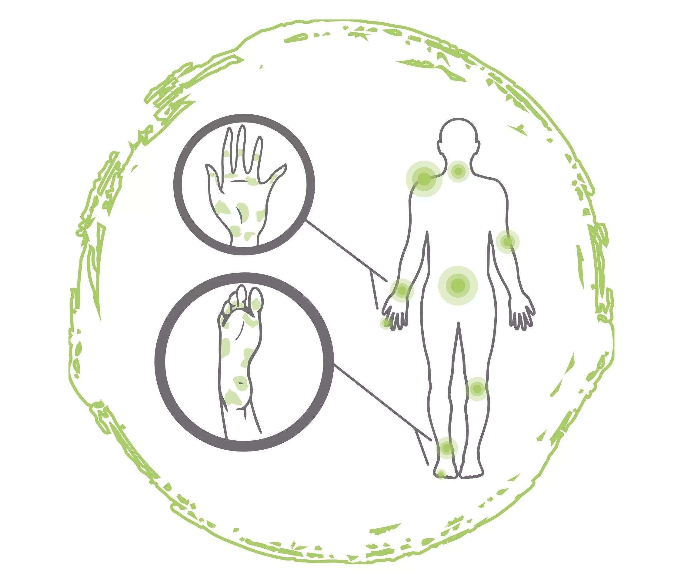 Psoriasis an Hand und Füßen