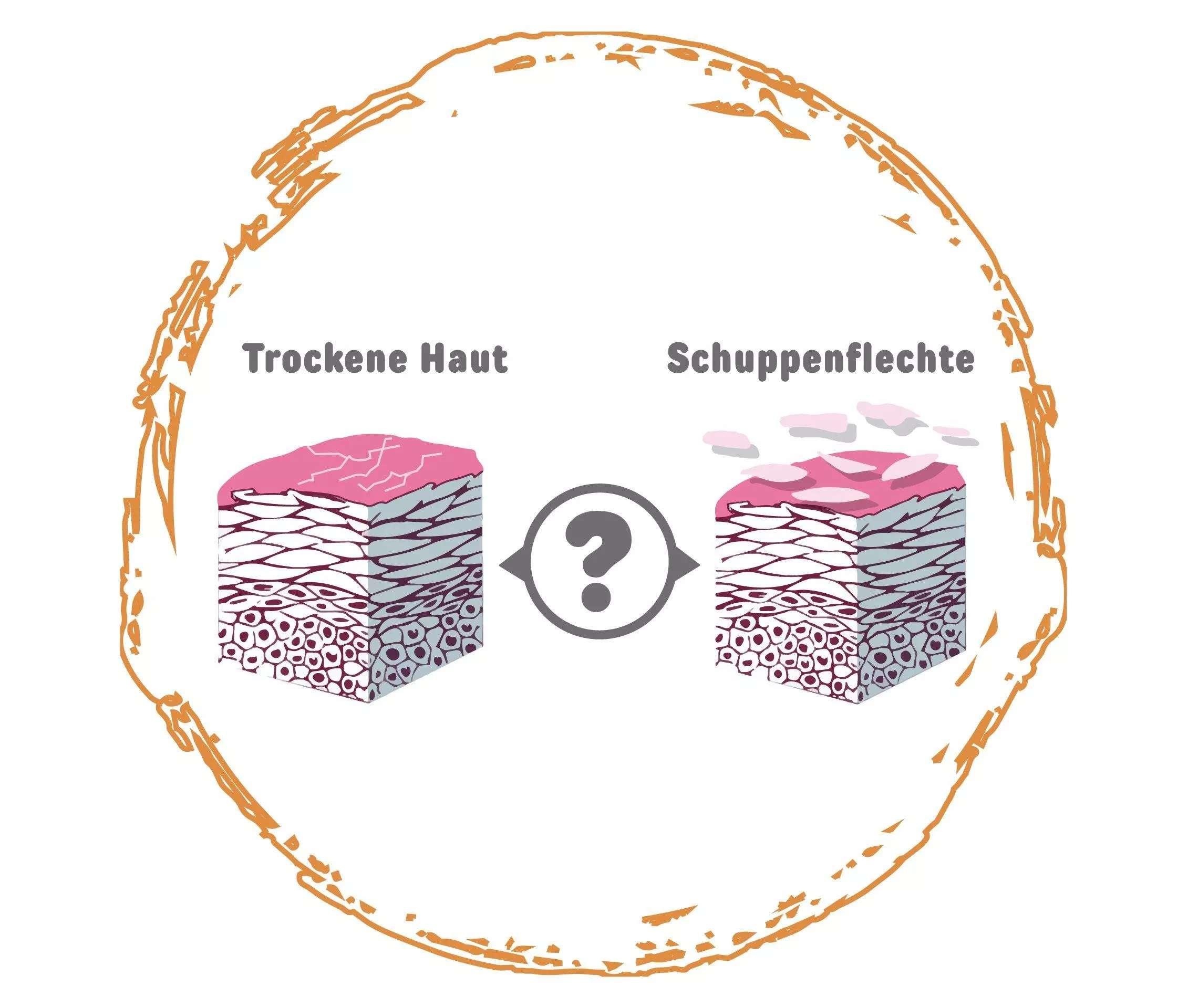 Schuppenflechte oder trockene Haut?