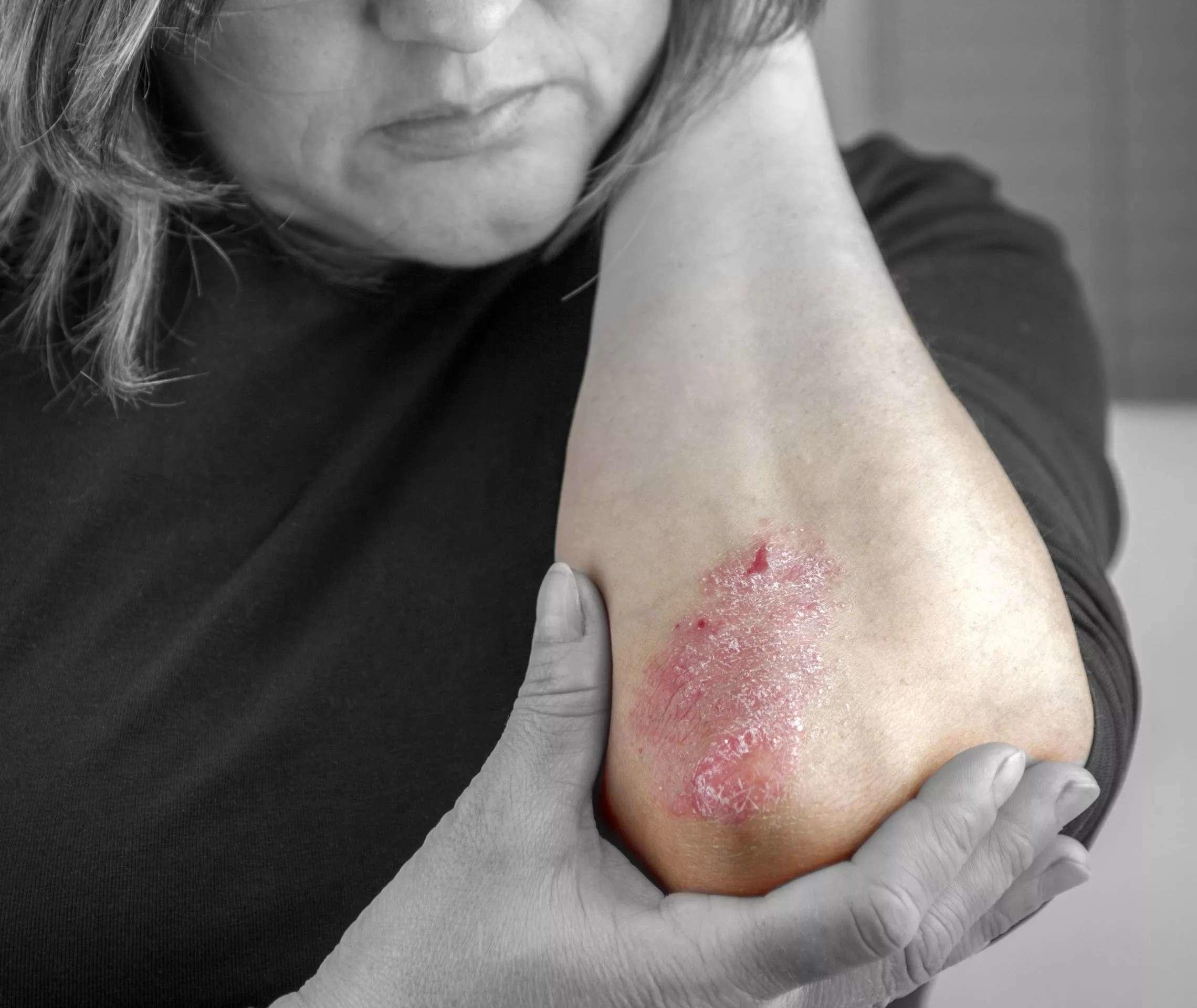 Psoriasis Infos Symptome Betroffene Bereiche