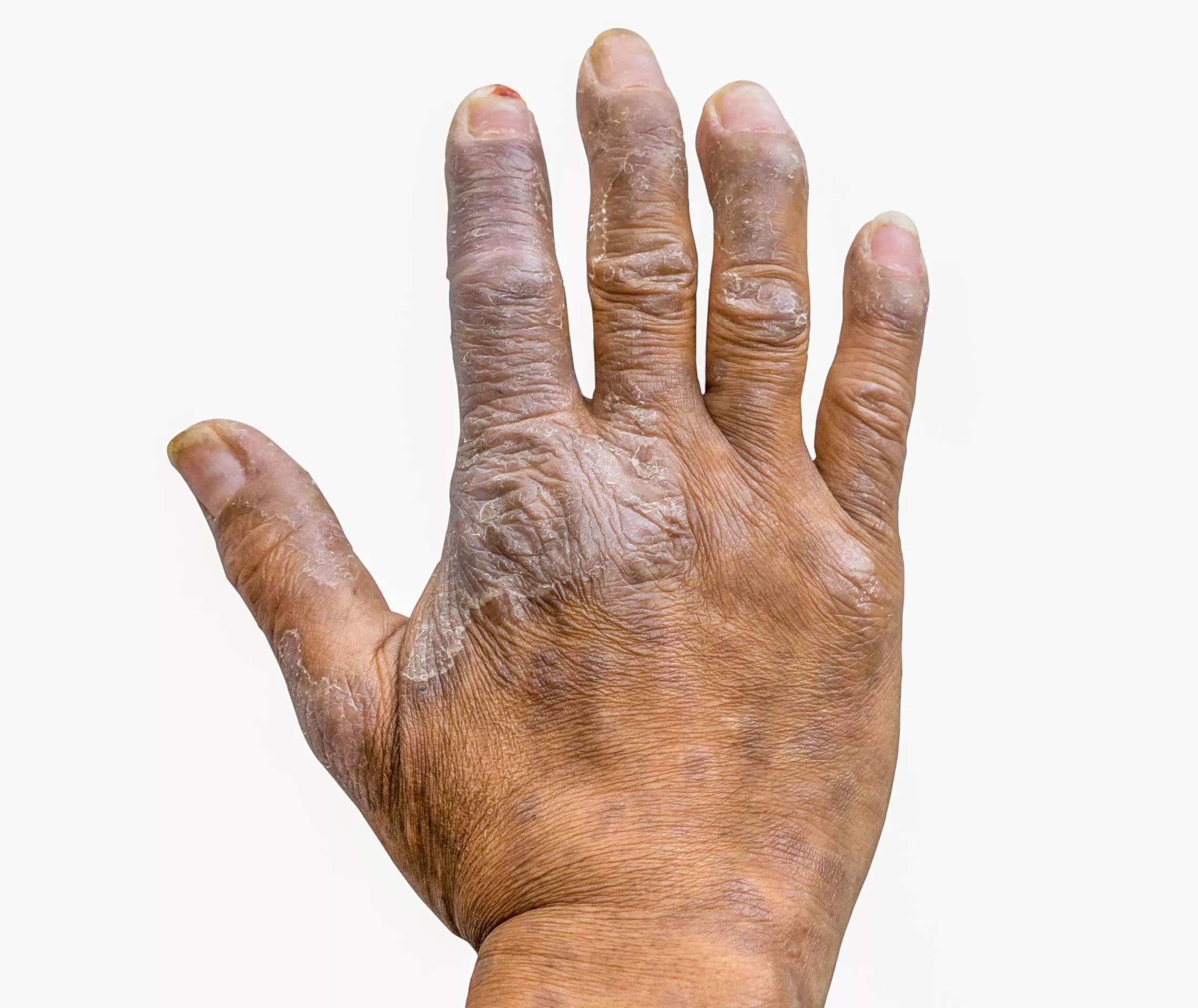 Psoriasis Info Symptome Nagelpsoriasis