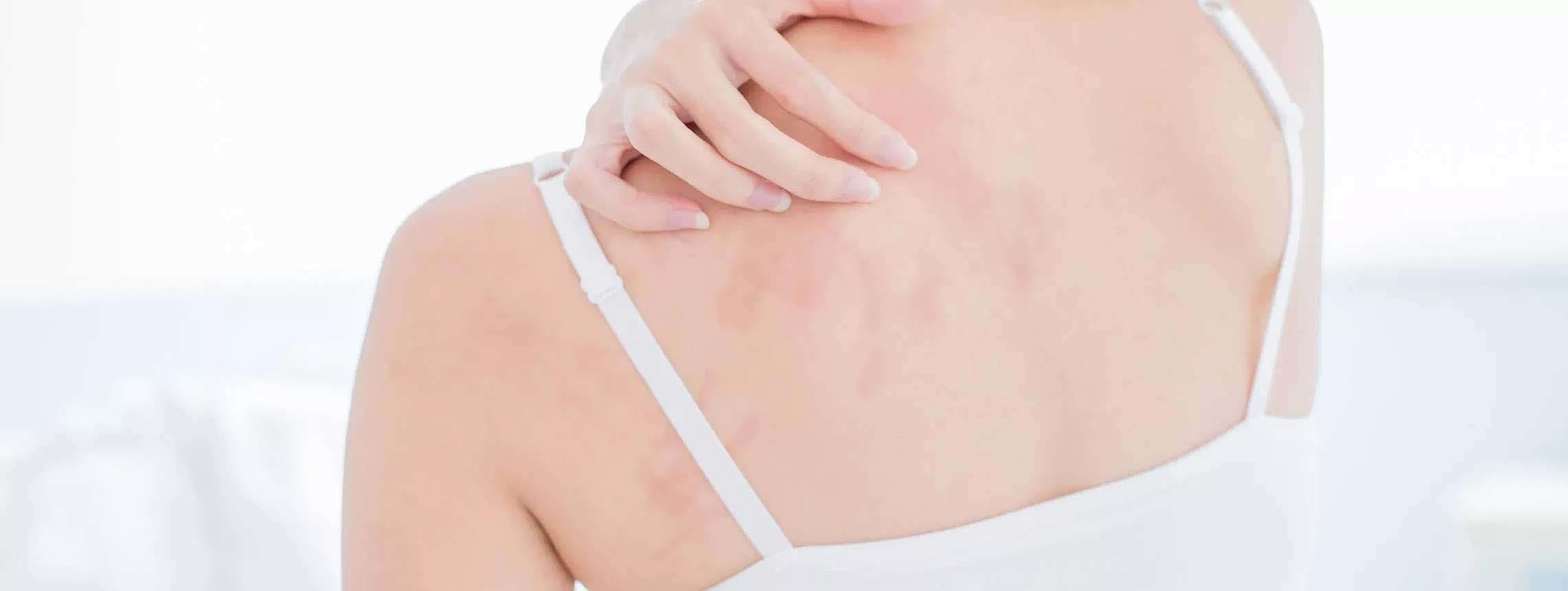 Psoriasis-Betroffene kratzt sich an der Schulter