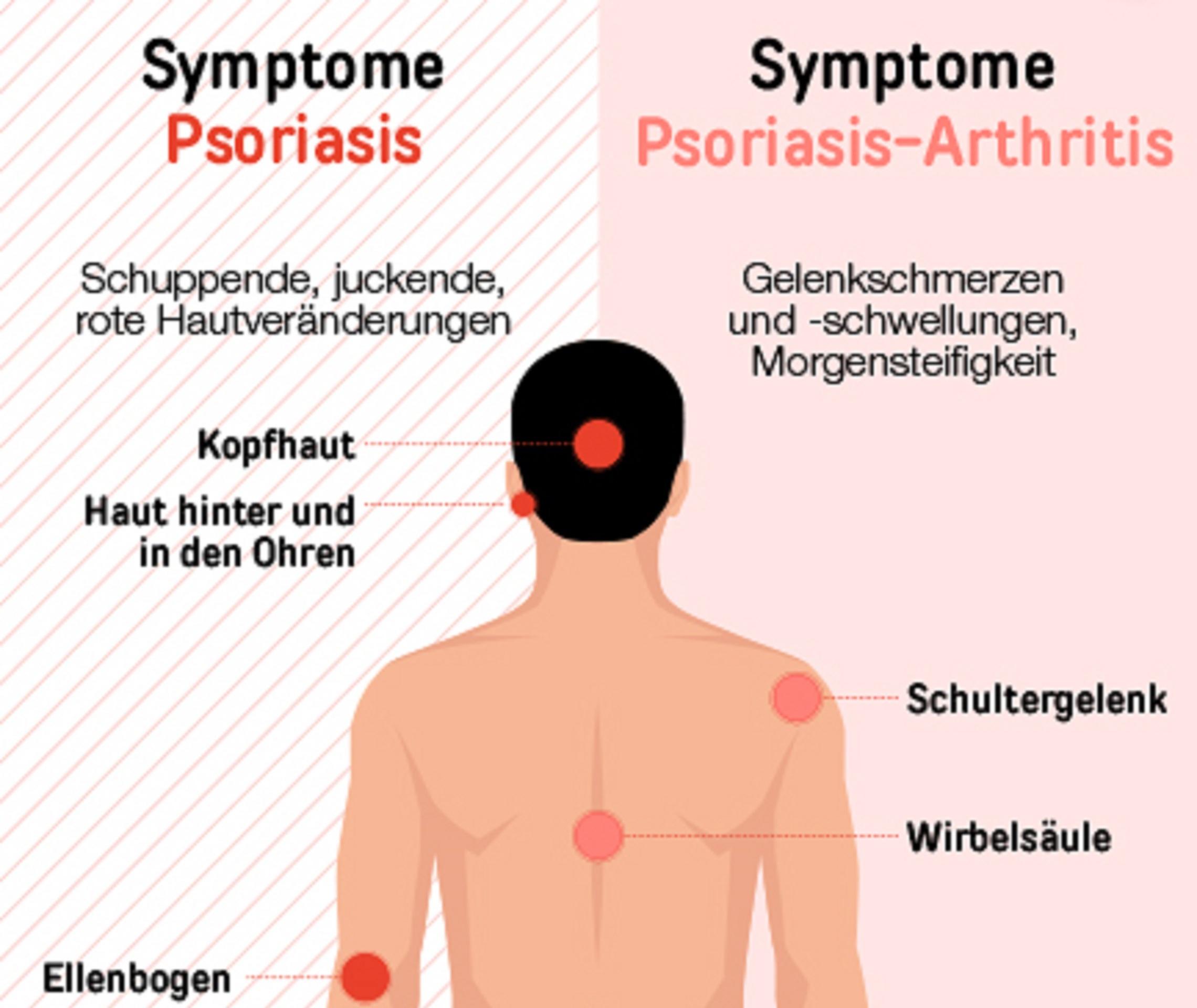 Psoriasis Guttata Rote Schuppige Flecken Psoriasis Info