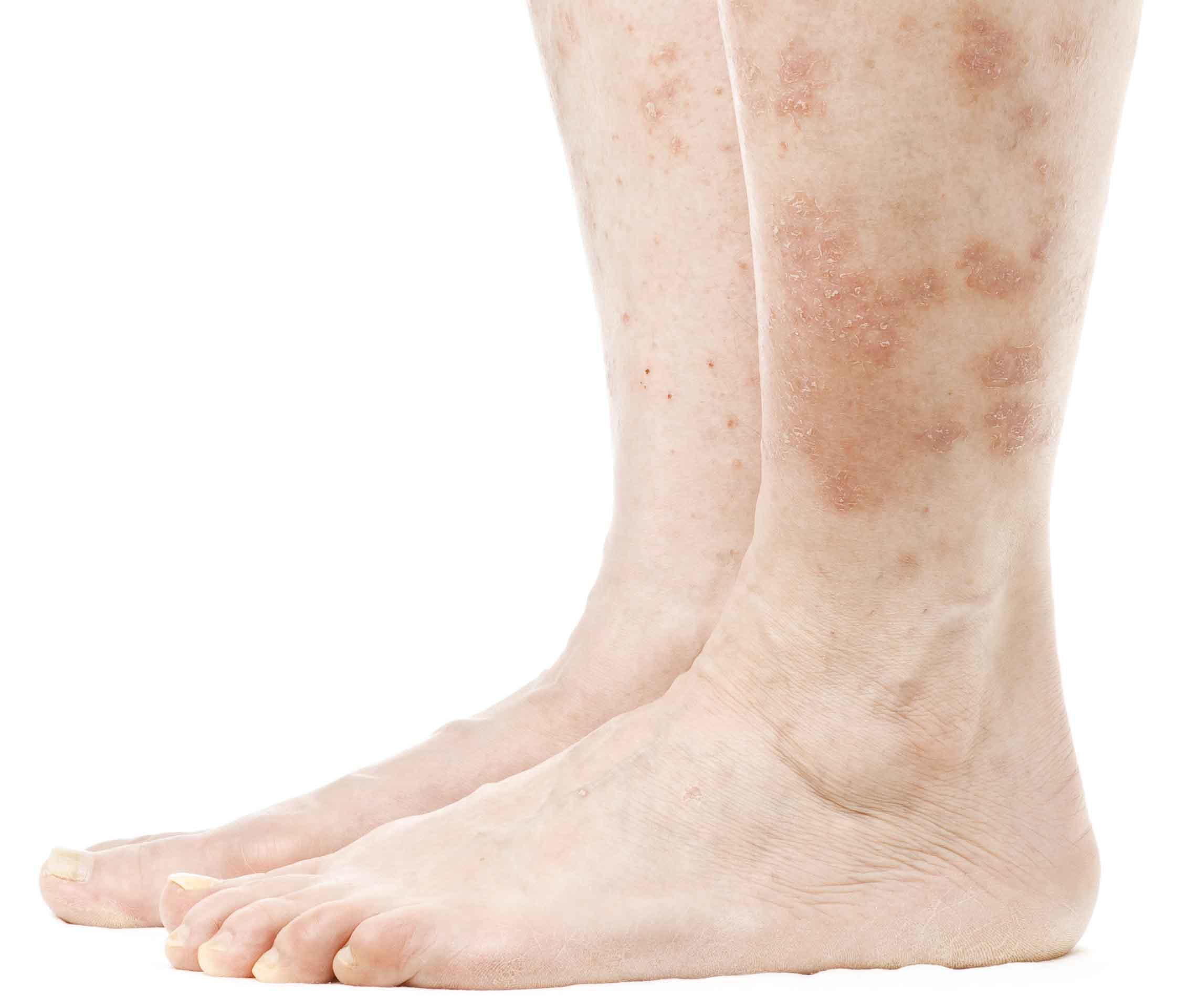 Welche Formen Von Schuppenflechte Gibt Es? | Psoriasis.info